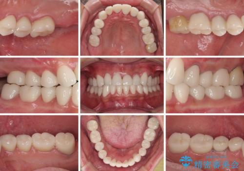 受け口傾向の咬み合わせを治したい 全顎セラミック治療の治療後