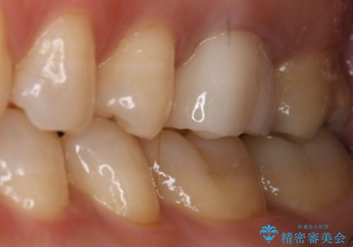 銀歯を白くしたい セラミックインレーの治療前