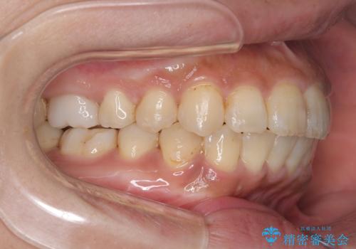 【ワイヤー矯正】前歯の凸凹を治したいの治療後