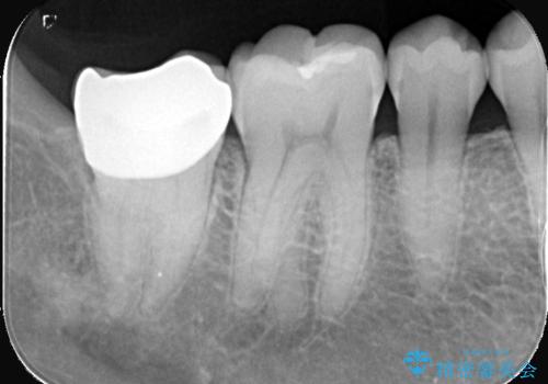 神経を残す治療|VPT|生活歯髄療法|オールセラミッククラウン|神経を残しながらクロスバイトの改善!の治療後