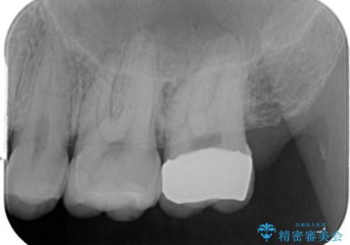 セラミックインレーとクラウンで歯ぐきの腫れを治すの治療後
