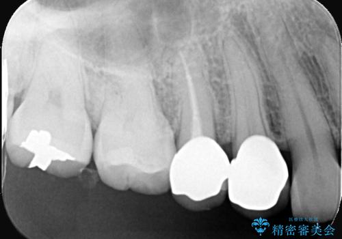歯が取れた症例に対するセラミッククラウンによる修復の治療後