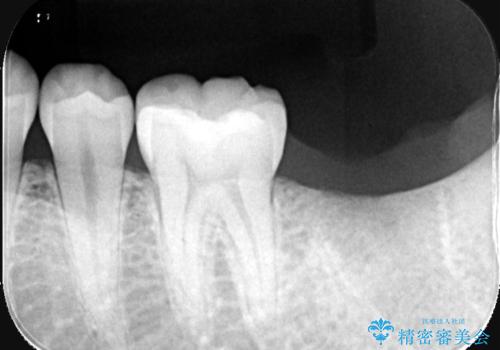 痛くないインプラント治療|1回の手術で終了!|エンドペリオ病変|オールセラミッククラウンの治療前