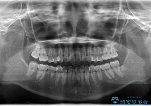 右下5番の先天欠如と前歯の叢生に対するワイヤー矯正とインプラント治療の治療前