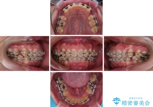 口が閉じられない 抜歯矯正で前歯の突出感を改善の治療中