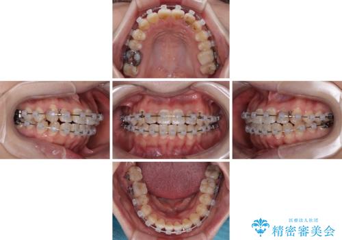むし歯と八重歯を治したい 総合歯科治療の治療中