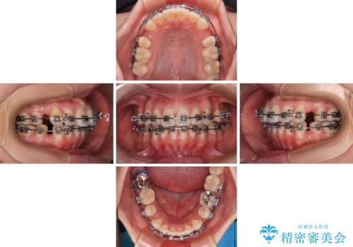 【モニター】口が閉じられない ワイヤー装置での抜歯矯正の治療中
