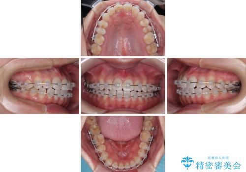 捻れた前歯を楽して改善 ワイヤー装置での非抜歯矯正の治療中
