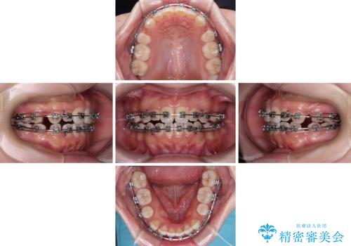 【モニター】舌突出癖で隙間が ワイヤー装置での抜歯矯正の治療中