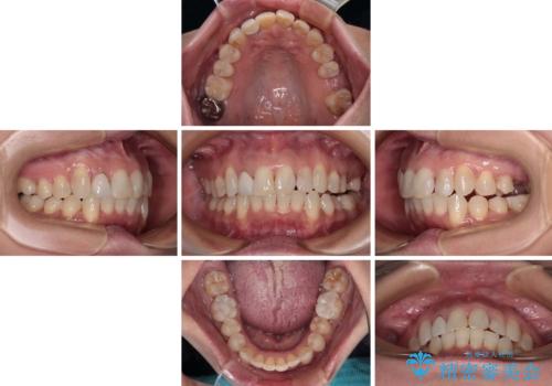 前歯のデコボコとむし歯治療の跡 インビザライン矯正とオールセラミッククラウン治療の治療中