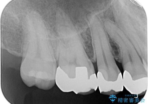 銀歯をセラミックに変えたいの治療前