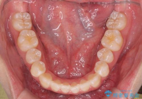上下すれ違った前歯の矯正治療の治療後