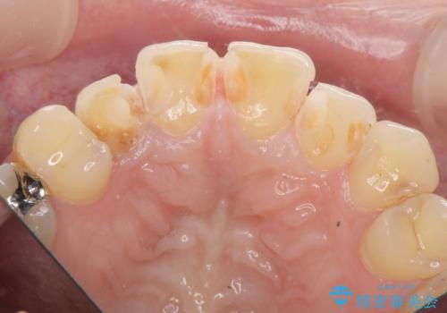 充填物の変色を繰り返す前歯のセラミック治療の治療中
