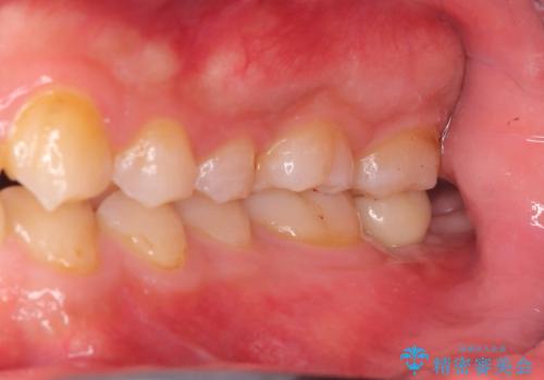 痛くないインプラント治療|1回の手術で終了!|エンドペリオ病変|オールセラミッククラウンの症例 治療後