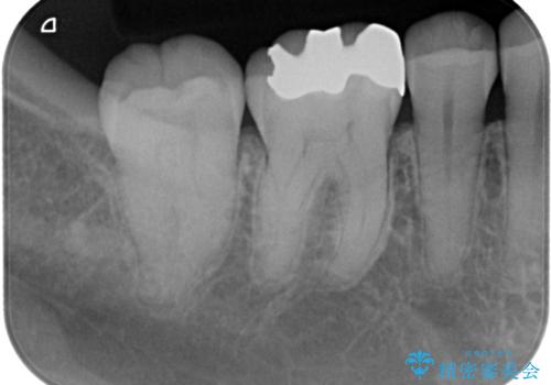 金属の詰め物が目立つのでやり替えたい ハイブリッドインレー修復の治療前