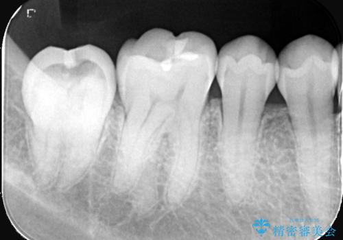 神経を残す治療|VPT|生活歯髄療法|オールセラミッククラウン|神経を残しながらクロスバイトの改善!の治療前