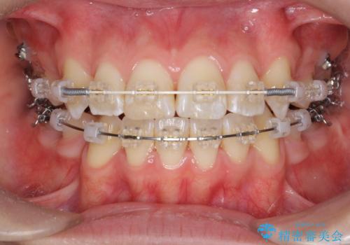 突き出た前歯を治したい 小臼歯抜歯+マルチブラケット矯正の治療中