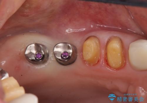 ブリッジのぐらつき インプラントを用いた奥歯の噛み合わせの再構築の治療中