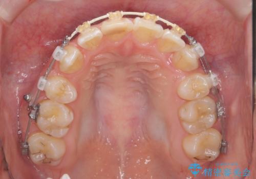 突き出た前歯を治したい 小臼歯抜歯+マルチブラケット矯正の治療中