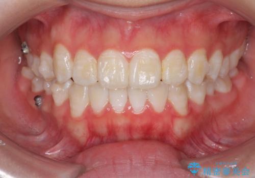 上下すれ違った前歯の矯正治療の治療中