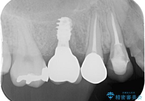 奥歯のインプラント治療の治療後
