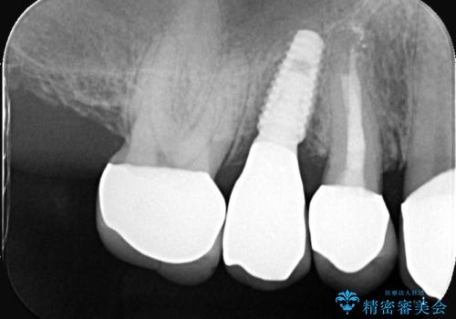 痛く無いインプラント治療!|残根状態の治療の治療後
