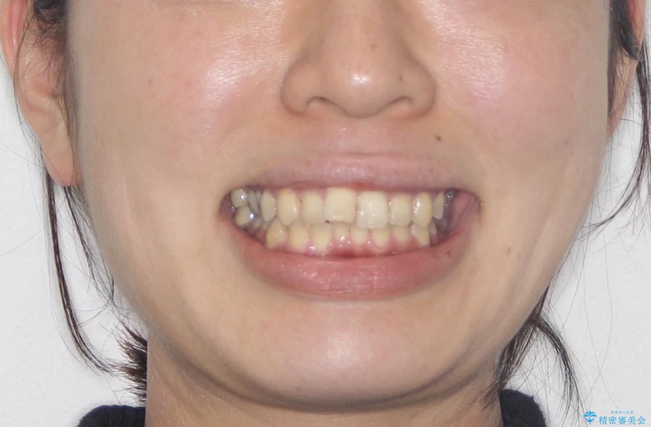 【ワイヤー矯正】前歯の凸凹を治したいの治療前(顔貌)