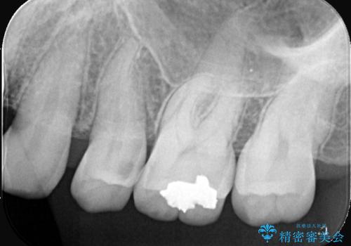 【セラミックインレー】ホワイトニングしに来たら虫歯が見つかったの治療前