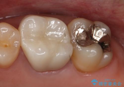 銀歯を白くしたい セラミックインレーの症例 治療前