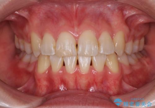 突き出た前歯を治したい 小臼歯抜歯+マルチブラケット矯正の症例 治療後