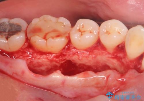 話すのに邪魔な、下顎骨隆起の切除の治療中