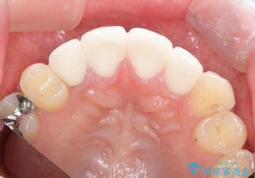 充填物の変色を繰り返す前歯のセラミック治療の治療後