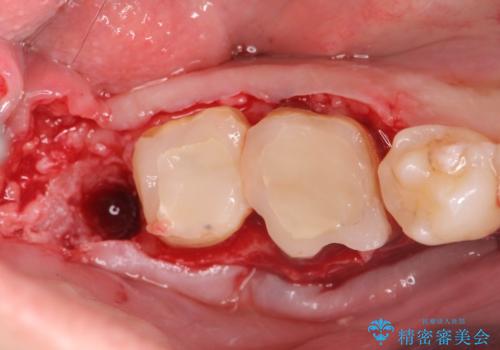 スペース狭小な銀歯を白くしたい 歯冠長延長術を併用したセラミック治療の治療中