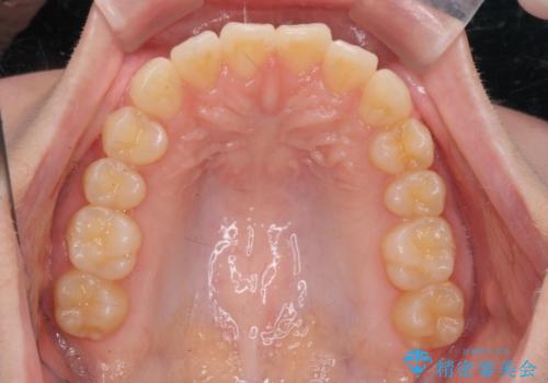 前歯のねじれをマウスピース矯正で治したいの治療後