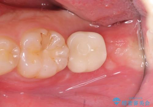 痛くないインプラント治療|1回の手術で終了!|エンドペリオ病変|オールセラミッククラウンの治療後