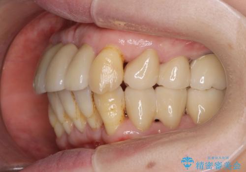 歯周病 、インプラント、 矯正 全顎治療の治療後