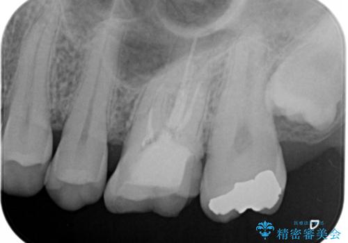 銀歯を白くしたい セラミックインレーの治療前