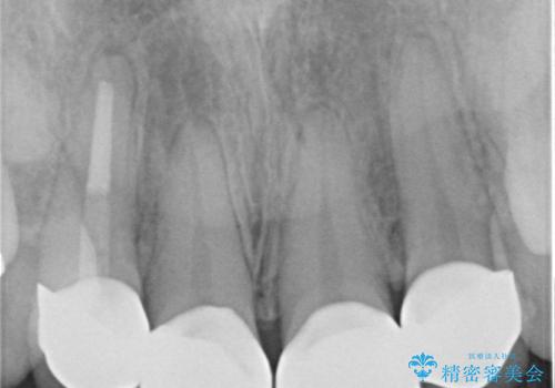 充填物の変色を繰り返す前歯のセラミック治療の治療後