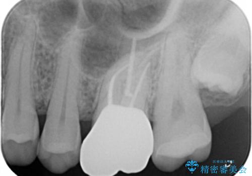 銀歯を白くしたい セラミックインレーの治療後