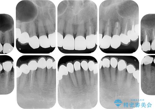 受け口傾向の咬み合わせを治したい 全顎セラミック治療の治療後