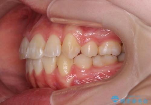 突き出た前歯を治したい 小臼歯抜歯+マルチブラケット矯正の治療後