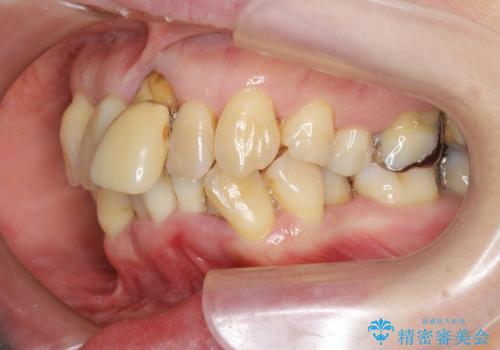 歯周病 、インプラント、 矯正 全顎治療の治療前