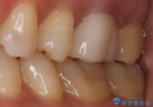 銀歯を白くしたい セラミックインレーの治療中