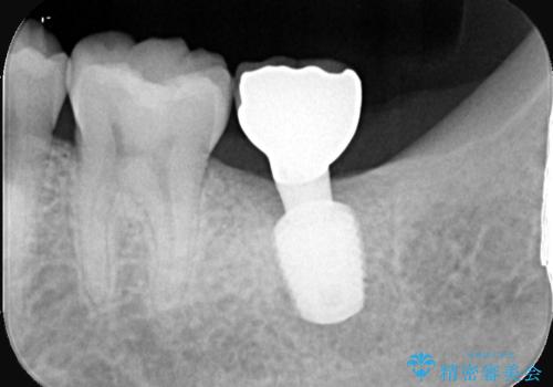 痛くないインプラント治療|1回の手術で終了!|エンドペリオ病変|オールセラミッククラウンの治療後