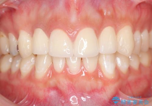 充填物の変色を繰り返す前歯のセラミック治療の治療後