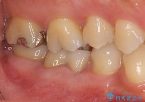 スペース狭小な銀歯を白くしたい 歯冠長延長術を併用したセラミック治療の治療後