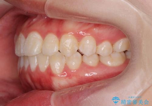 上下すれ違った前歯の矯正治療の治療後