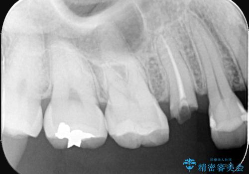 歯が取れた症例に対するセラミッククラウンによる修復の治療前