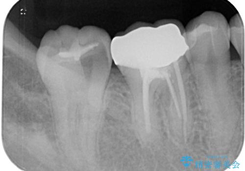 大きな虫歯ができて歯に穴が開いた オールセラミッククラウンの治療前