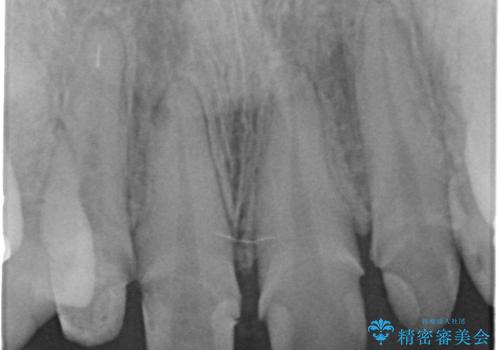 充填物の変色を繰り返す前歯のセラミック治療の治療中